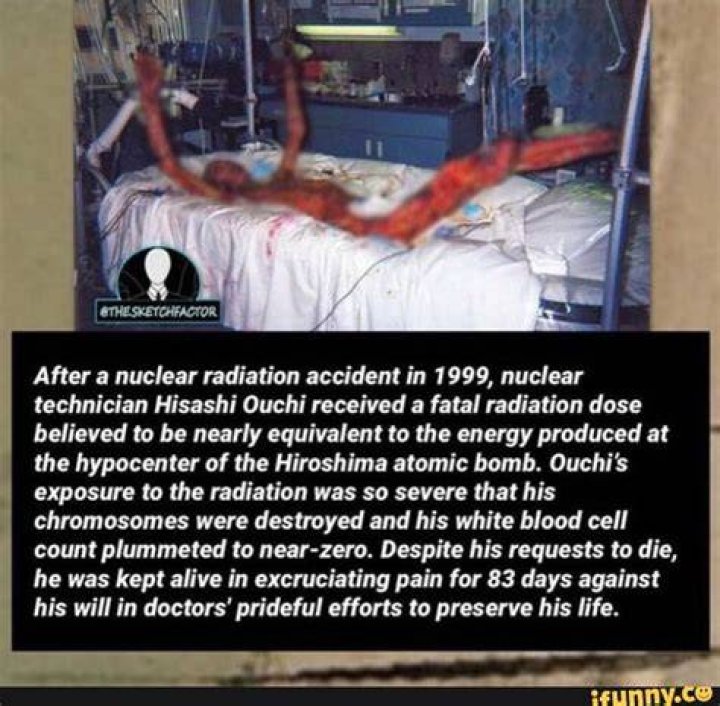 Beware Of Graphic Content: Grisly Photos Of Hisashi Ouchi's Radiation Burns
