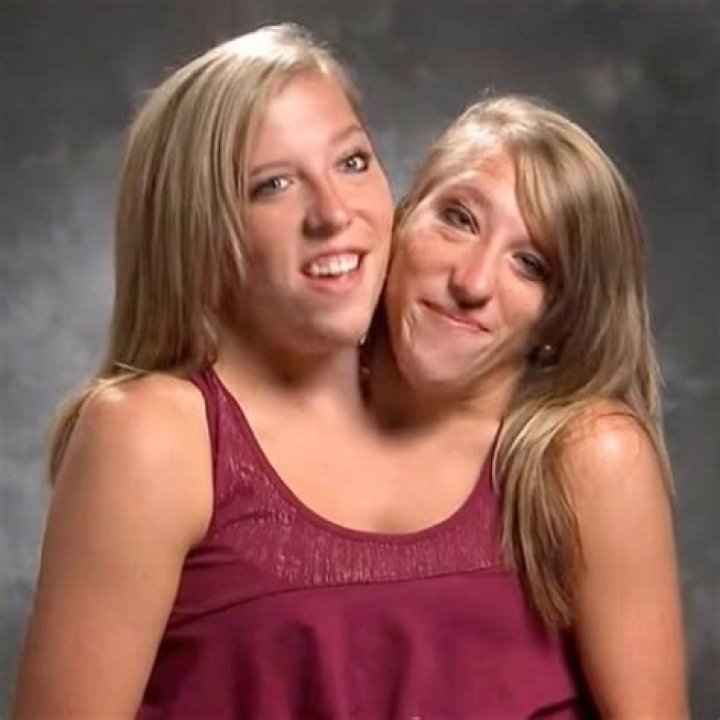 Conjoined Twins Abby And Brittany Hensel's Pregnancy Journey