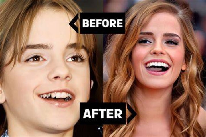Did Hermione have buck teeth? Celebrity.fm #1 Official Stars, Business & People Network, Wik ·