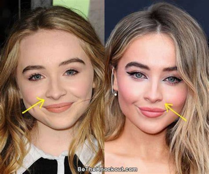 Discover The Truth: Sabrina Carpenter's Lip Filler Journey Revealed