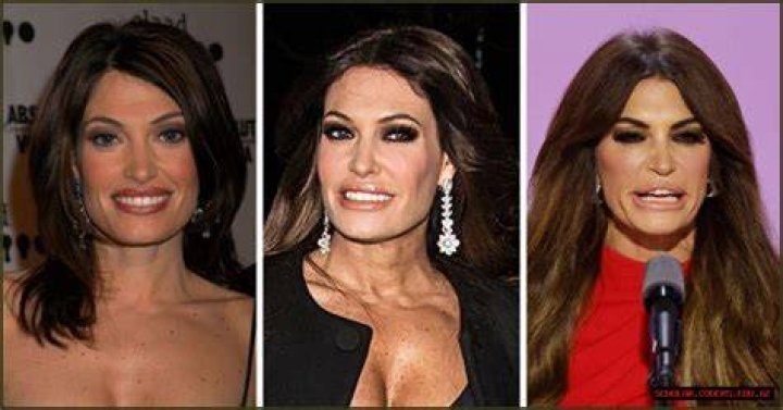 Exploring The Transformation: Kimberly Ann Guilfoyle's Plastic Surgery Journey