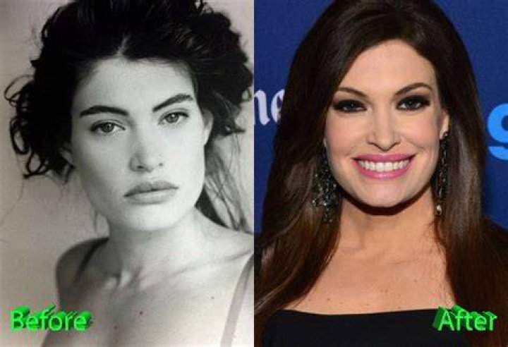 Has Kimberly Guilfoyle's Plastic Surgery Transformed Her Appearance?