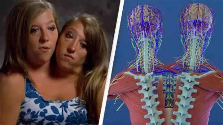 Incredible Anatomy Of Conjoined Twins Abby And Brittany Hensel