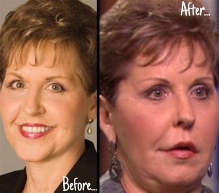 Joyce Meyer Face Surgery: Uncovering Truths And Unveiling Secrets