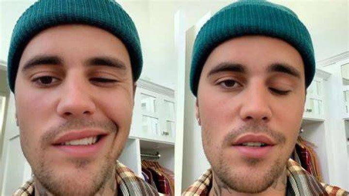 Justin Bieber Qu&eacute; es el s&iacute;ndrome de Ramsay Hunt, la condici&oacute;n que