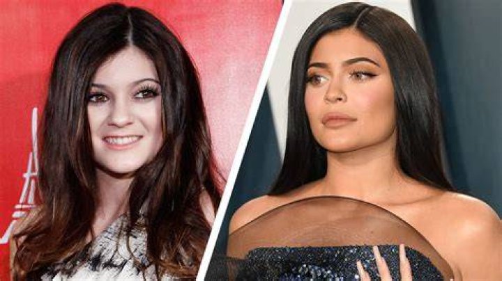 Kylie Jenner's Before And After Transformation: Unveiling The Secrets