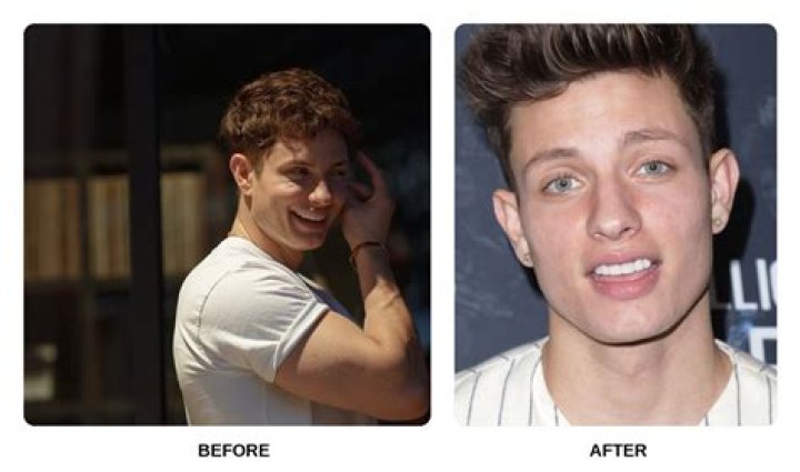 Matt Rife Before Dental