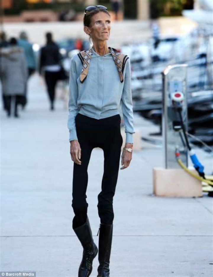 Meet The Thinnest Person In The World: An Extraordinary Tale Of Survival