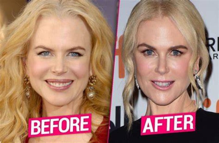 Nicole Kidman&rsquo;s Plastic Surgery Transformation Top Docs Claim