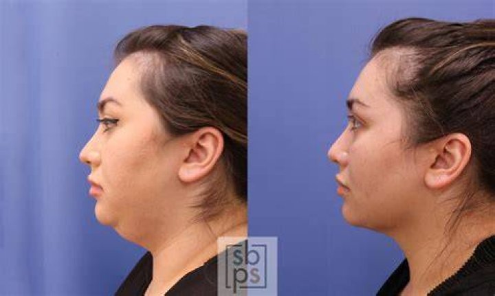 Patient 200 Female Liposuction Before and After Photos Katy Plastic