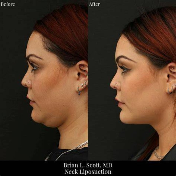 Patient Q&A Neck Liposuction Dermatology, Laser & Vein Specialists