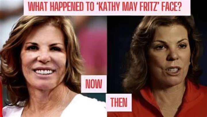Plastic Surgery Transformations Of Kathy May Fritz