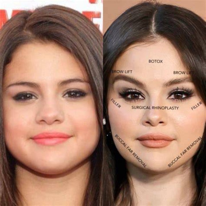Selena Gomez Plastic Surgery Of Face, Nose and Breast With Before and
