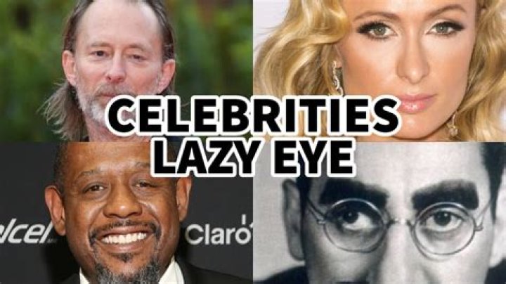 The Journey Of Actors With Lazy Eye