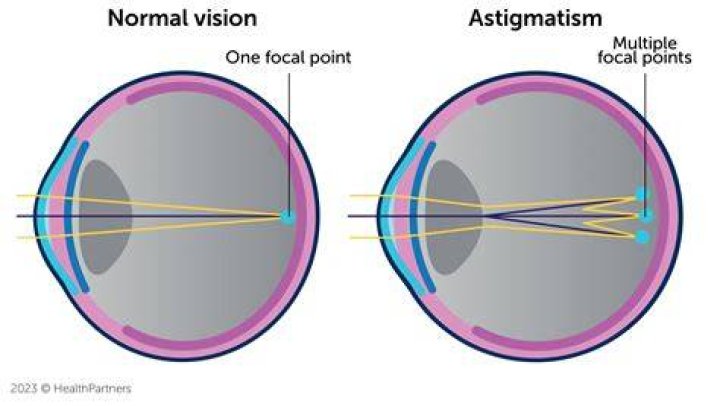 Uncover The Secrets Of Astigmatism Through Revealing Images
