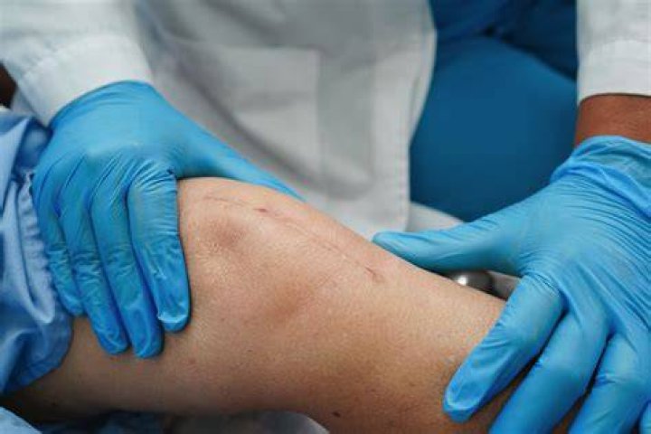 Uncover The Startling Truth About Botched Knee Liposuction