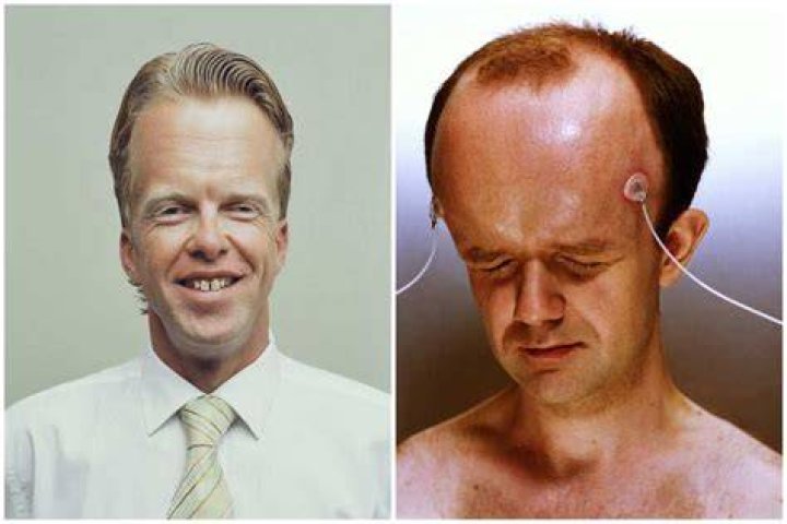 Uncovering The Individual With The World's Diminutive Forehead