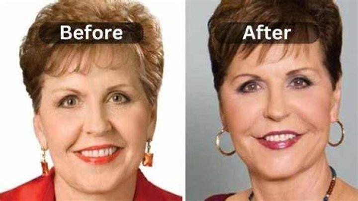 Unveiling Joyce Meyer's True Face: Before The Knife