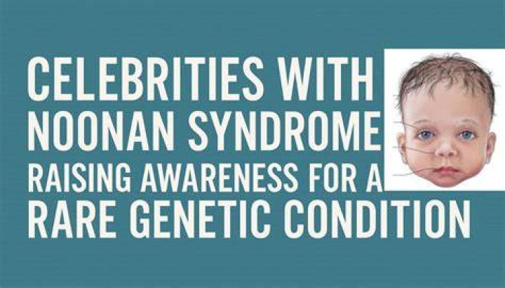 Unveiling The Faces Of Noonan Syndrome: Celebrities With The Rare Genetic Disorder