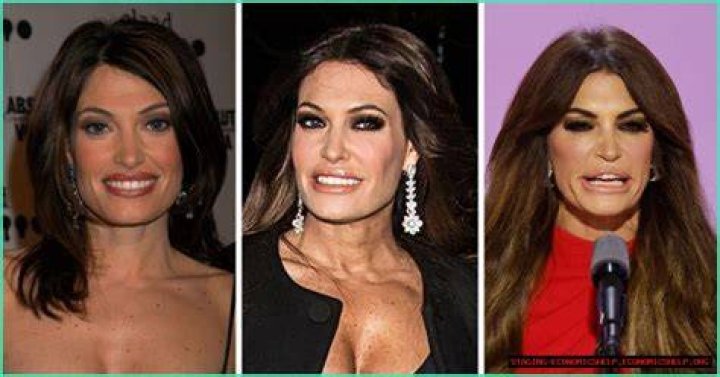 Unveiling The Secrets Behind Guilfoyle Botox: The Beauty Treatment Of A Powerhouse