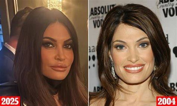 Unveiling The Truth Behind Kimberly Guilfoyle Lip Surgery