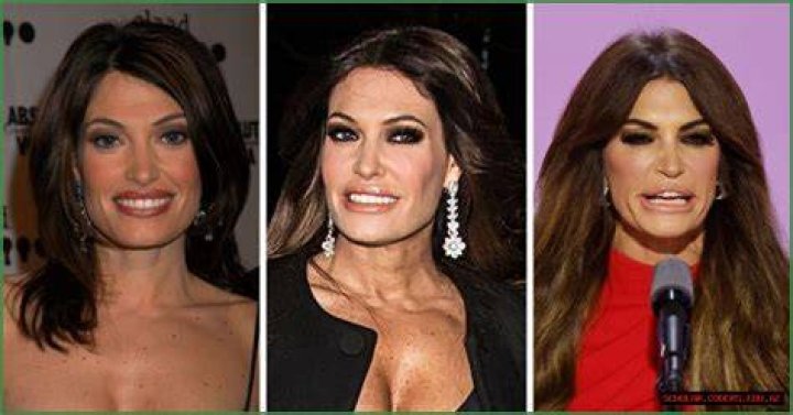 Unveiling The Truth: Kimberly Guilfoyle's Journey Through Plastic Surgery