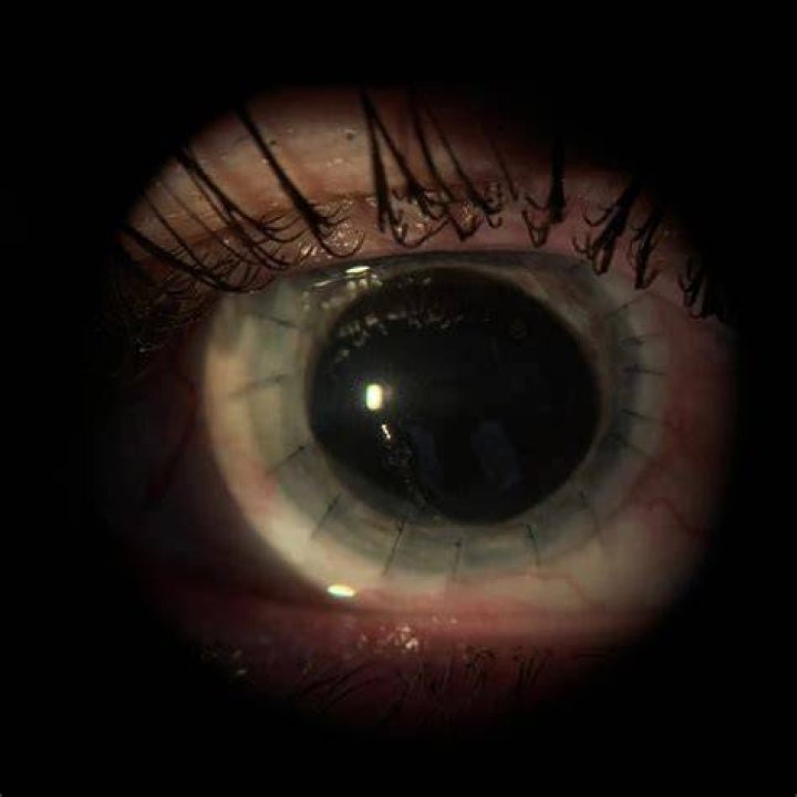 Vision after corneal transplant? r/Keratoconus