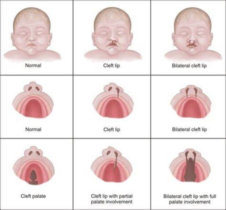 What&rsquo;s an Orofacial Cleft? Cleft Lip and Cleft Palate Explained GoodRx