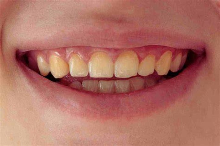 Why do swimmers have yellow teeth? |