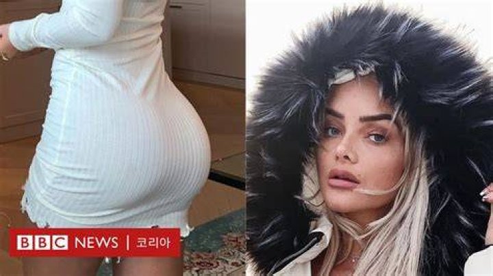 엉덩이 확대 수술 '내가 엉덩이 보형물을 빼기로 한 이유' BBC News 코리아